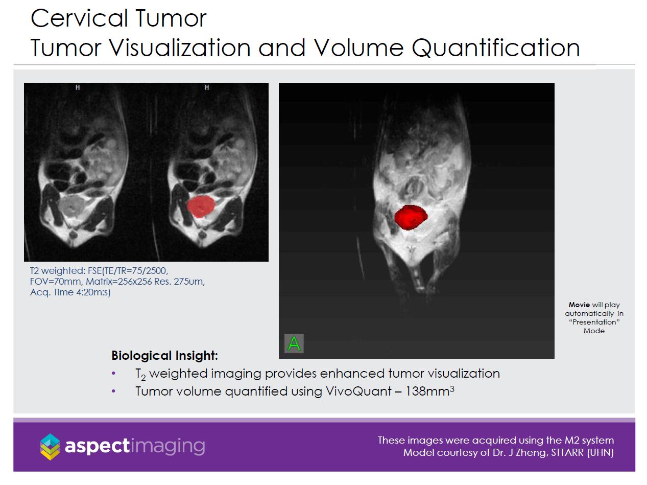 Tumor Visualization and Volume Quantification